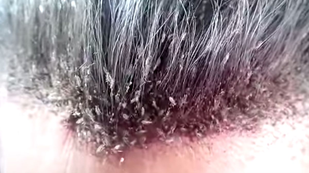 What are the precautions you can take for head lice?
