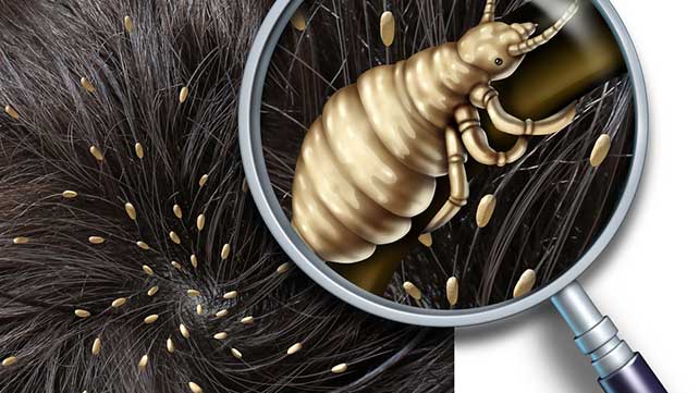 Reliable Solution to Lice Infestation in Indianapolis 